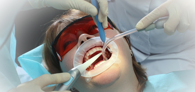 Профессиональная чистка зубов для профилактики развития кариеса